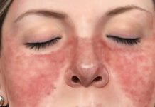 LOS SÍNTOMAS DEL LUPUS