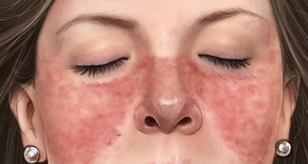 Lupus